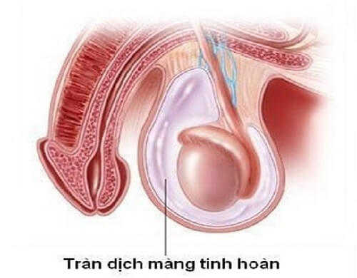 Tràn dịch màng tinh hoàn
